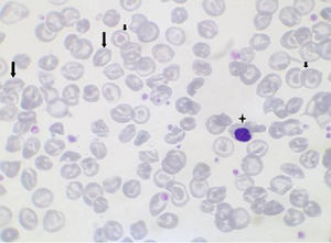 Blood film of the proband. Blood film showing anisocytosis, poikilocytosis, microcytosis, hypocromia, stomatocytes (arrows), target cells (small arrows), erythroblasts (cross) and macroplatelets.