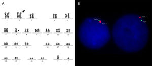 (A) Karyotype (G-band): 45,XY,add(2)(q35),-7[20]. (B) FISH (Del (7q) Deletion Probe, ref: RU-LPH 025; Cytocell, Cambridge, UK): Deletion of RELN gene (chromosome 7) in 96% of the analyzed nuclei. The absence of a green and a red signal may indicate the monosomy of the chromosome.