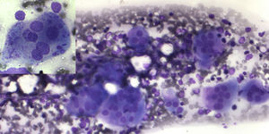 Bone marrow aspirate (200× Leishman stain) – osteoclasts cluster - inset osteoclast with ingested material.