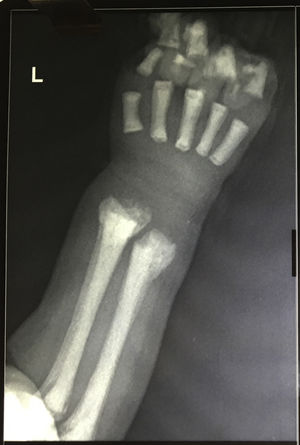 X-ray anterior–posterior view of the forearm – bone in bone appearance.