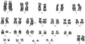 Abnormal karyotype identified by G-banding with a translocation involving chromosome 8 and 13: 46,XY,t(8;13)(q22;q11)[4]/46,XX[28].