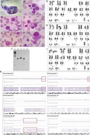Bone marrow morphological, cytogenetics and molecular analysis of Case 1. (A) Hypercellular bone marrow fragment. The bone marrow was stained with Wright-Giemsa stain and the images show: (B) myeloblasts, (C) dyserythropoiesis with karyorrhexis, (D) dyserythropoiesis with binucleate erythroid precursor and nuclei/cytoplasm asynchronous maturation, (E) myeloid precursor with hypogranulation cytoplasm and (F) dysplastic small megakaryocytes with monolobed nuclei. The G-banded karyotype revealed 46,XY,t(9;22)(q34;q11),del(20)(q11)[2]/46,idem,inv(7)(q22q36)[6]/47,idem,inv(7)(q22q36),+19[12]; illustrative metaphase (G–I). The t(9;22)(q34;q11) is indicated with blue arrows, the del(20)(q11) is indicated with a green arrow, the inv(7)(q22q36) is indicated with a red arrow and the +19 is indicated with a black arrow. (J) Polymerase chain reaction for b2a2/b3a2 and e1a2 BCR-ABL1 transcripts – 1: ladder 50 base pairs (Life Technologies); 2: Case 1; 3: positive control for b2a2/b3a2 BCR-ABL1 transcript (p210); 4: positive control for e1a2 BCR-ABL1 transcript (p190); 5: negative control for b2a2/b3a2 and e1a2 BCR-ABL1 transcripts. (K) Single nucleotide polymorphism array (SNP-A)-based karyotyping using Affymetrix Genome-Wide Human SNP Cytoscan HD. Signals at the top of each panel represent copy number status. The lower panel represents genotyping calls or the frequency of A and B alleles. Deletions are illustrated by a decrease in the copy number and a change in genotyping; interstitial deletion in chromosome 2, 7 and 20 are highlighted with a red box. The del(7)(q36) was not identified by metaphase cytogenetics. Normal copy number and three genotypes were observed in chromosome 19 by SNP-A. Chromosomes 9 and 22 presented normal copy number and genotypes by SNP-A.