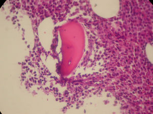 Hypercellular bone marrow at the expense of plasma cell infiltration (Hematoxylin and eosin stain: Magnification: 100×).