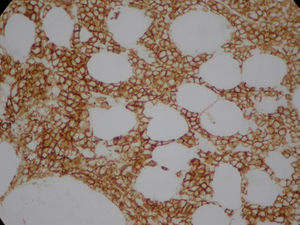 CD138 plus plasmocytes.