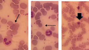 Blood smear of the patient with passenger lymphocyte syndrome. Full arrow shows polychromasia, dotted arrow shows microspherocyte and broad arrow shows erythroblast.