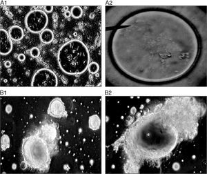 Morphology of liposomes examined under oil-immersion objective lens (total magnification 1000×). (A) Untreated control, (B) Colistin-treated [additional optical zoom: A1 and B1 (2×), A2 and B2 (3×)].