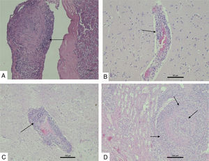 Histopathological alterations observed in MCF in tissues of animal 798/07. (A) Carotid rete mirabile with moderate mononuclear inflammatory infiltration and hyalinization of the tunica adventitia (H & E 200× magnification). (B) Cerebral cortex with moderate mononuclear perivascular cuffing in gray matter and mononuclear infiltrate in meninges (non-purulent meningo-encephalitis) (H & E 200× magnification). (C) Thalamus with intense mononuclear perivascular cuffing in the neuropil (H & E 100× magnification). (D) Kidney. Renal cortex with intense mononuclear inflammatory infiltrate and hyalinization in the tunica media and adventitia (H & E 100× magnification).