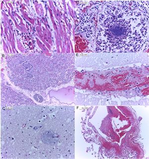 Histopathological findings associated with Histophilus somni in sheep. There is necrotizing myocarditis (A), bronchopneumonia (B), bacterial emboli within the brain (C) and lung (D), and thrombosis at the cerebrum (E) and choroid plexus (F). Bar: A, C-E, 0.02mm; B and F, 0.1mm.