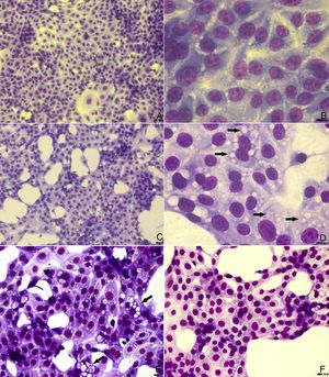 Light microscopy analysis of bovine viral diarrhea virus (BVDV) infected cells treated with prostaglandin A1 (PGA1). MDBK cells were treated with PGA1 for 36h, and then subjected to panoptic staining. Low and high magnification images of untreated mock-infected cells (A, B), and of infected cells kept untreated (C, D) or treated with 5 (E) and 10 (F) μg/mL PGA1. Although 5μg/mL PGA1 strongly blocked BVDV replication (E), it did not inhibit the vacuolization process (arrows). Vacuolization inhibition was only achieved after treatment with 10μg/mL PGA1 (F). Scale bars: 8μm.