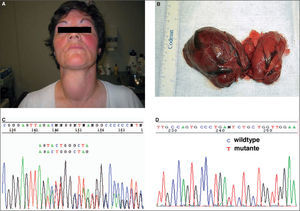 Paciente de 43 años con sordera y bocio (A) a expensas sobre todo del lóbulo tiroideo derecho en donde había varios nódulos tiroideos grandes (B). La paciente es portadora de dos mutaciones diferentes (heterocigota compuesta) en el gen SLC26A4, c.279delT que causa una alteración en la pauta de lectura en el exón 3 (C), y c.578C>T en el exón 5 (D).