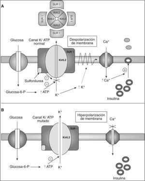 Representación esquemática de la secreción insulínica. A: funcionamiento normal de los canales de potasio dependientes de adenosintrifosfato (ATP) en la célula beta y el mecanismo de acción de las sulfonilureas. B: consecuencias de la mutación de la subunidad Kir6.2 en los canales de potasio dependientes de ATP en la secreción de insulina. Glucosa-6-P: glucosa 6 fosfato; Kir6.2: subunidad del poro del canal de K+ sensible a ATP; SUR1: receptor de sulfonilureas.