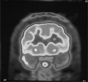 Tomografía por emisión de positrones. La flecha indica la glándula hipofisaria con una hipercaptación anormal que muestra el adenoma.