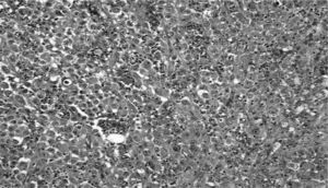 Angiosarcoma epitelioide de tiroides: tumor difuso formado por células epitelioides (H-E, ×200).