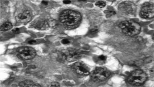 Angiosarcoma epitelioide de tiroides: presencia de células aberrantes que delimitan luces ocupadas por hematíes (H-E, ×400).