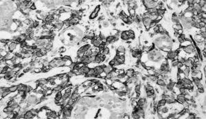 Angiosarcoma epitelioide de tiroides: marcada positividad tumoral para CD31.