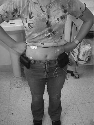 Adolescente que porta la bomba infusora de insulina insertada en su hemiabdomen derecho y el monitor continuo de glucosa en el izquierdo.