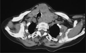 Tomografía computarizada del tiroides. Se observa un bocio multinodular con compresión traqueal.