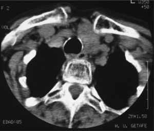 Tomografía computarizada del cuello a los 2 años de tratamiento con radioyodo. Se observa significativa reducción del bocio y resolución de la compresión de estructuras adyacentes.