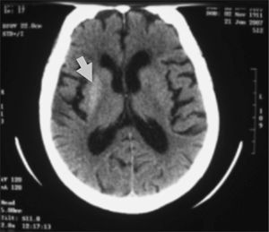 Tomografía computarizada craneal: hiperintensidad de señal en el putamen derecho.