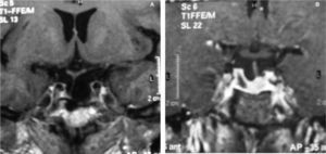 A: caso 1. Resto tumoral izquierdo de 1 × 0,5cm con desplazamiento del tallo hipofisario hacia la derecha. B: caso 2. Resto tumoral derecho 1,2cm con desplazamiento del tallo hacia la izuierda.