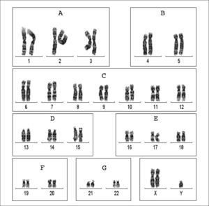 Cariograma con tinción de bandas G correspondiente a un varón con síndrome de Klinefelter. Los cromosomas se ordenan y clasifican en grupos según el tamaño y la posición del centrómero. A: grandes, metacéntricos. B: grandes, submetacéntricos. C: tamaño medio, metacéntricos o submetacéntricos; el cromosoma X se incluye también en este grupo. D: tamaño medio, acrocéntricos con satélites. E: relativamente pequeños, metacéntricos o submetacéntricos. F: pequeños, metacéntricos. G: pequeños, acrocéntricos con satélites; incluye el cromosoma Y.