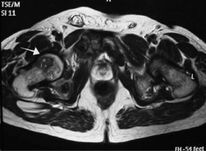 Imagen de lesión (flecha blanca) de osteítis fibrosa quística en la resonancia magnética de la región pelviana.