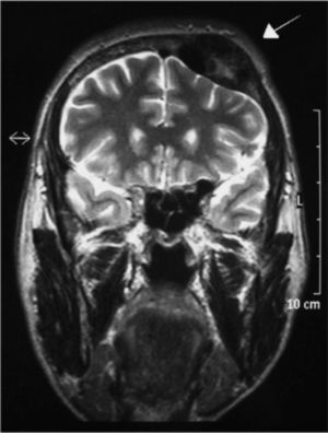 Resonancia magnética craneal que muestra lesión de osteítis fibrosa quística (flecha blanca) en la región frontal izquierda.