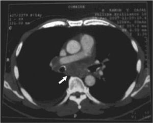 Tomografía computarizada que muestra adenopatías en ventana aortopulmonar, subcarinales, hiliares derechas.