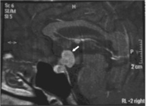Resonancia magnética craneal antes del inicio de la quimioterapia, que muestra una lesión de 14 mm en la parte anterior del tercer ventrículo, en relación con tallo y quiasma.