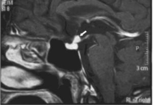 Resonancia magnética craneal realizada en los dias posteriores al primer ciclo de quimioterapia; muestra clara disminución del tamaño de la lesión.