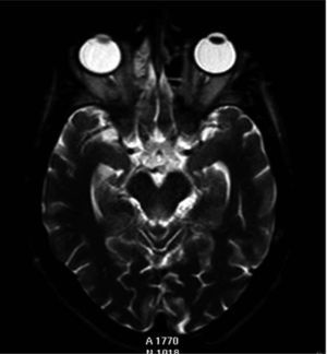 Imagen axial TSE-T2 single shot que muestra el mesencéfalo, donde se observa una hiperintensidad de señal periacueductal