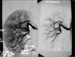 Imagen típicamente arrosariada de fibrodisplasia de arteria renal. Aspecto tras el procedimiento de dilatación.