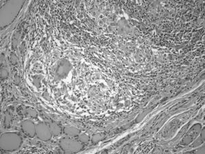 Imagen histológica de un granuloma tuberculoso no necrotizante en la glándula tiroidea del caso descrito.