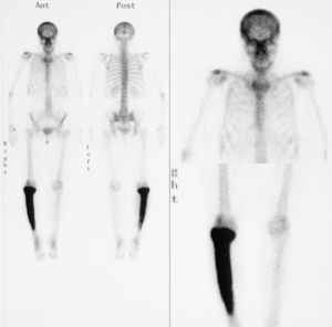 Gammagrafía ósea con aumento de actividad osteogénica en calota y dos tercios superiores de la tibia.