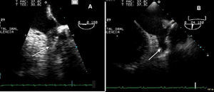 A) Ecocardiografía transesofágica inicial con trombo en orejuela izquierda (flecha). B) Ecocardiografía transesofágica 5 semanas después, sin trombo en orejuela izquierda (flecha).