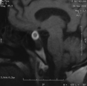 Tumoración intrahipofisaria de 1,3×1,4×1,5 cm, discretamente lateralizada a la derecha, que no invade seno cavernoso y contacta con el quiasma óptico. Presenta un halo hiperintenso sugestivo de hemorragia.