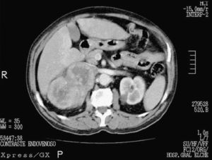 Tomografía axial computarizada de abdomen, en la que se muestra gran masa polilobulada dependiente de la glándula suprarrenal derecha.