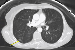 Tomografía computarizada de torax que muestra infiltrado nodulillar (flecha) en pulmón derecho.
