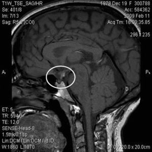Resonancia magnética hipotálamo-hipofisaria: hipoplasia hipofisaria con neurohipófisis ectópica.