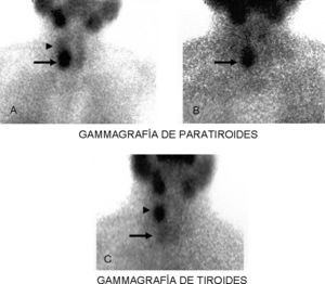 Gammagrafía de paratiroides: imágenes estáticas centradas en región anterocervical a los 10min. A) Fase precoz. B) Fase tardía (2h) de la inyección de 99mTc-sestamibi. Foco de intensa hipercaptación situado a la altura de la mitad inferior del lóbulo tiroideo derecho (flecha), que presenta un lavado más lento que el resto del parénquima tiroideo en la imagen tardía, compatible con adenoma de paratiroides. C) La gammagrafía de tiroides con 99mTc-pertecnetato, realizada a continuación, muestra un foco de hipercaptación en tercio superior del lóbulo tiroideo derecho (punta de flecha) en relación con adenoma hiperfuncionante de tiroides.