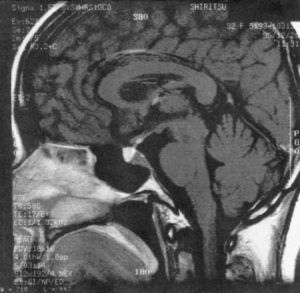 Imagen sagital de resonancia magnética T1 postadministración de contraste que muestra la presencia de una lesión selar-paraselar con afectación hipotalámica.