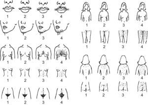 Ferriman–Gallwey hirsutism scoring system. Each of the nine body areas most sensitive to androgen is assigned a score from 0 (no hair) to 4 (frankly virile), and these separate scores are summed to provide a hormonal hirsutism score. [Reproduced from Evaluation and treatment of hirsutism in premenopausal women: an Endocrine Society Clinical Practice Guideline.43]