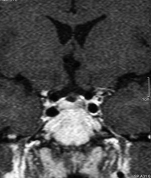 Resonancia magnética nuclear coronal que muestra un área hipocaptante en la vertiente izquierda de la glándula hipofisaria.