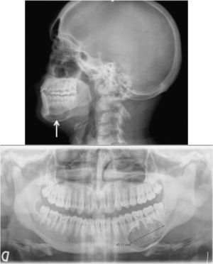 Lesión osteolítica correspondiente al fibroma osificante en la porción horizontal izquierda de la mandíbula, visto en la radiografía simple de cráneo (arriba, flecha) y en la ortopantomografía (abajo). Además se aprecia ausencia de lámina dura de los dientes.