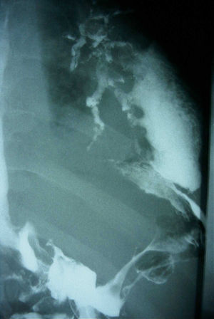Imagen de tránsito esófago-gástrico que muestra el paso de contraste baritado a los bronquios del lóbulo inferior izquierdo con rellenado del absceso pulmonar por existencia de una fístula entero-bronquial (fundus-curvatura mayor gástrica).
