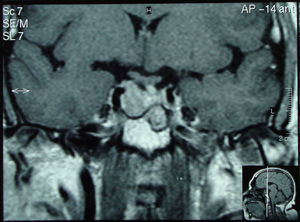 Resonancia magnética hipofisaria: corte coronal. Macroadenoma hipofisario con invasión de seno cavernoso dereho y extensión suprasellar con desplazamiento del quiasma.