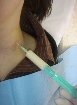 Punción diagnóstica de tumefacción postoperatoria de color blanquecina (linfa) característica de la lesión del conducto torácico o uno de sus afluentes.