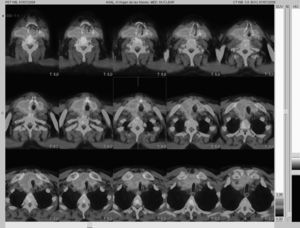 Imagen de PET-TC cervical que muestra una masa hipercaptante a nivel tiroideo, con infiltración de estructuras vecinas: tráquea, esófago, vena yugular interna y músculos pretiroideos.