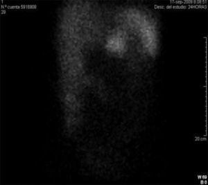 Imagen de la gammagrafía con 111In-DTPA-D-Phe-octreótido.