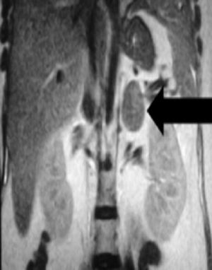 Imagen de resonancia magnética abdominal de una tumoración en glándula suprarrenal derecha sugestivo de adenoma cortical.